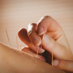 Young woman getting acupuncture treatment