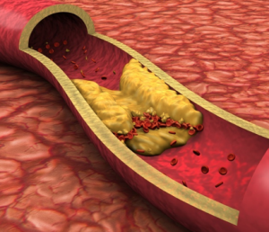 The search for an early biomarker for atherosclerosis - Hospital News