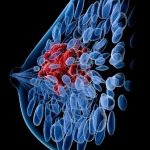 cnesh_trastuzumab