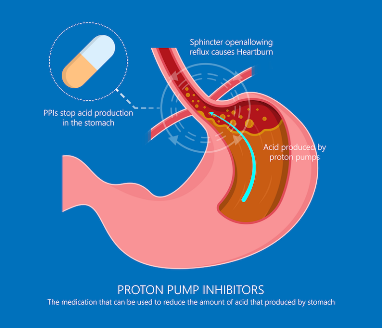 Proton-pump inhibitors: Is it time to re-evaluate your treatment?