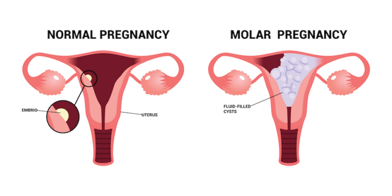 Discovery of new genes for molar pregnancies sheds light on their increased incidence in women aged 35 and over